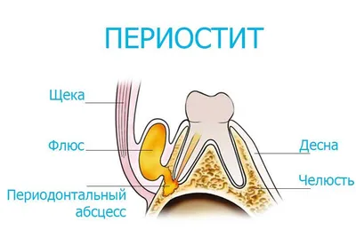 Что такое флюс и почему требуется лечение в стоматологии – ЧЕline |