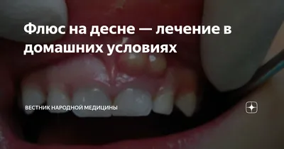 Флюс. ЧТО ДЕЛАТЬ и как лечить?