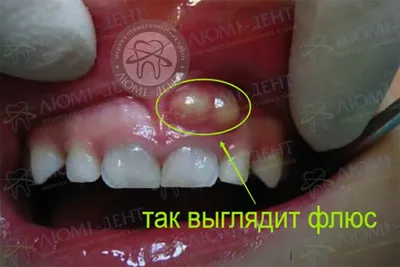 Белый прыщик на десне: причины появления, диагностика и лечение - белое  образование на десне