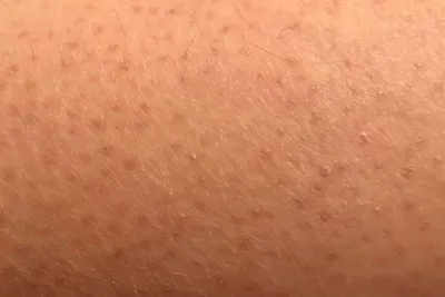 Пилярный кератоз ( фолликулярный, «гусиная кожа», keratosis pilaris) ⠀ Фолликулярный  кератоз у детей является распространенным безвредным… | Instagram