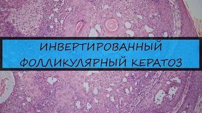 Фолликулярный кератоз, или гусиная кожа: какой уход поможет с ней  справиться | Vogue Russia