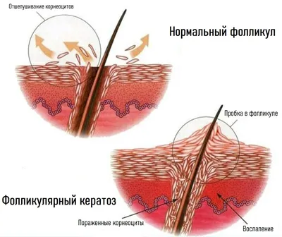 Фолликулярный (пилярный) кератоз - МЦ Парацельс Екатеринбург