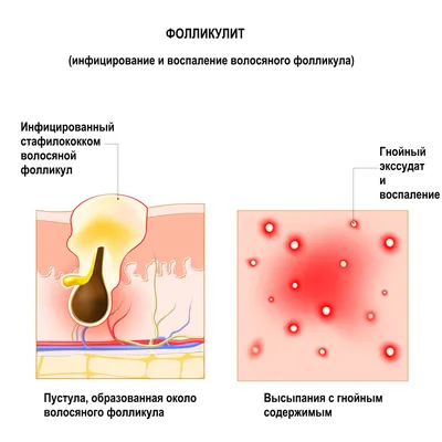 Фолликулит - причины появления, симптомы заболевания, диагностика и способы  лечения