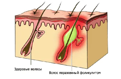 Фолликулит на коже человека стоковое фото ©ocskaymark 154051520