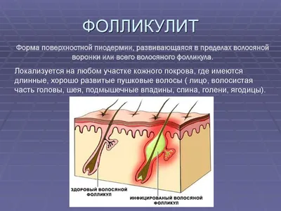 Фолликулит - Консультация Дерматолога Онлайн iDerma