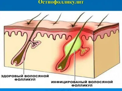 ПОДРЫВАЮЩИЙ ФОЛЛИКУЛИТ ГОФМАНА - YouTube