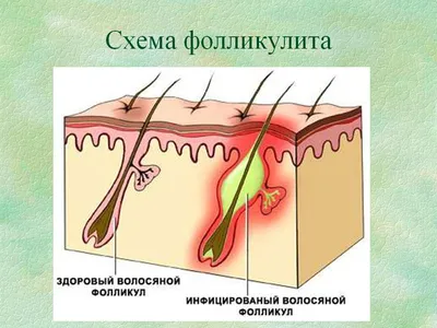 Фолликулит. Причины, симптомы и лечение