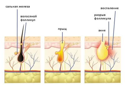 Бактериальный фолликулит у собак / Canine bacterial folliculitis