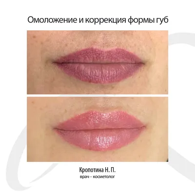 Идеальные формы губ, или как красиво нарисовать губы? | DermaQuest | Дзен