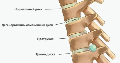 Протрузия межпозвоночного диска. Протрузия шейного, поясничного,  крестцового отдела позвоночника. Симптомы, лечение, операция – Отделение  вертебрологии НКЦ №2 (ЦКБ РАН)