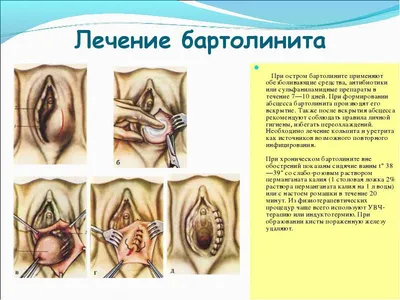 Бартолинит - фото, симптомы, причины и лечение