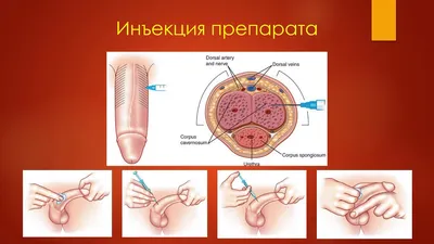 45-летний Миша из Берлина стал обладателем самого большого пениса в мире -  KP.RU