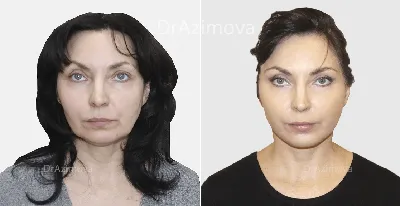 Процедуры инъекции липолитиков от 1990 руб/мл - BeautyWay Clinic 8 (499)  393-36-16