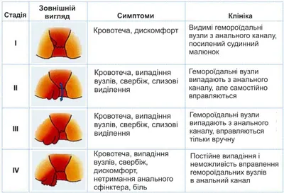 Геморрой: причины, симптомы, стадии, виды, осложнения, профилактика