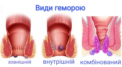 Лікування геморою п'явками