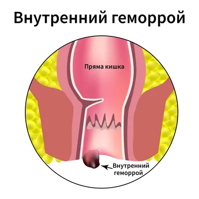 Свечи от гемороя Chlorhexidine Acetate Suppositories (id 56139336), купить  в Казахстане, цена на Satu.kz