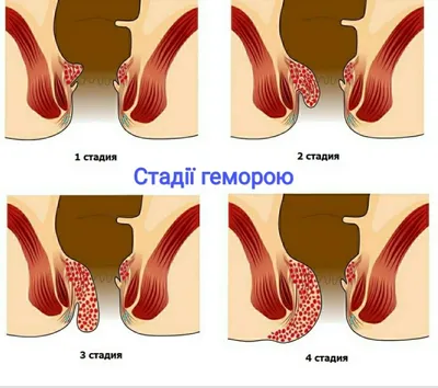 Лікування геморою п'явками