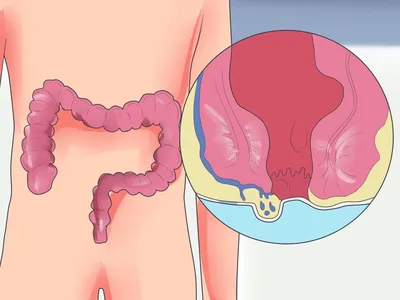 Геморрой: причины, симптомы, стадии, виды, осложнения, профилактика