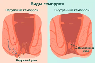 Фото геморроя