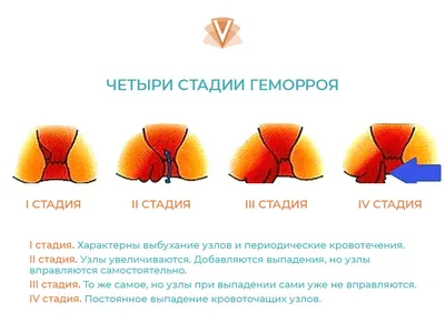 Эффективное лечение геморроя в медицинском центре | Клиника Частная  врачебная практика в Челябинске