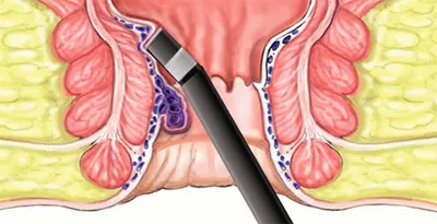 Внутренний геморрой - причины, диагностика и лечение