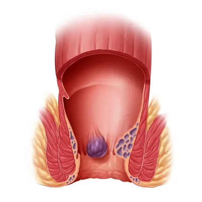 Внутренний геморрой: симптомы, диагностика, лечение - Клиника Доктора  Гришина
