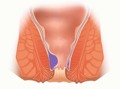 Геморрой – причины, симптомы, диагностика и способы лечения заболевания |  Клиника Будь Здоров