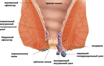 Внутренний геморрой: причины, диагностика и лечение - квалифицированная  помощь