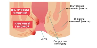 Эффективное лечение внутреннего геморроя - блог Виртус