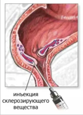 Геморрой – симптомы, причины, как лечить