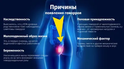 Лечение геморроя с тромбозом в медицинском центре «Я здоров», цены в  Новосибирске