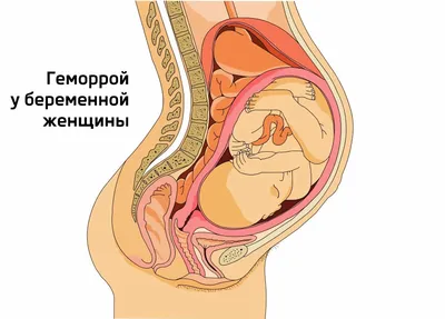 Геморрой как он есть и как его лечить, чтобы не было мучительно больно