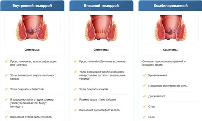 Як починається геморой (ранні симптоми)