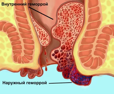 Геморрой — (клиники Di Центр)