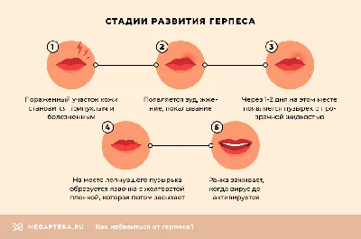 Клиническое течение, диагностика и современная адекватная терапия  генитального герпеса у женщин – тема научной статьи по клинической медицине  читайте бесплатно текст научно-исследовательской работы в электронной  библиотеке КиберЛенинка