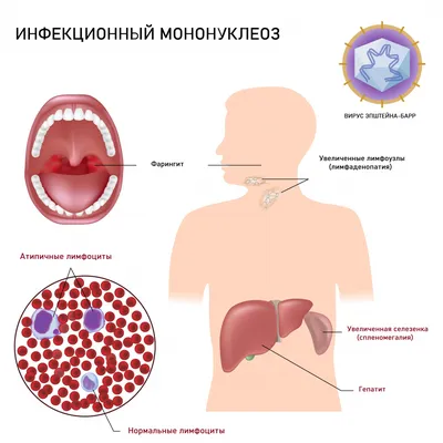 Как лечить генитальный герпес на половых органах