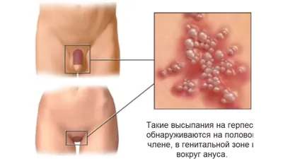 Вирус Эпштейна–Барр - причины появления, симптомы заболевания, диагностика  и способы лечения