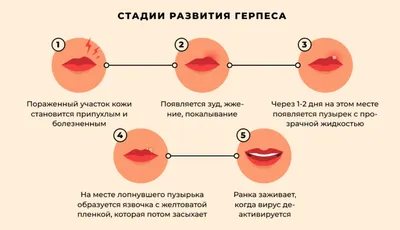 Что нужно знать о герпесе? / Новости/Акции - Том Терра