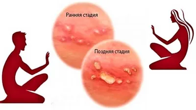 Герпес у ребенка | Детская клиника Фэнтези