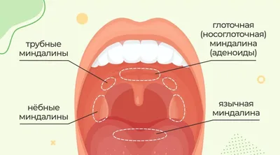 Тонзиллит - причины появления, симптомы заболевания, диагностика и способы  лечения