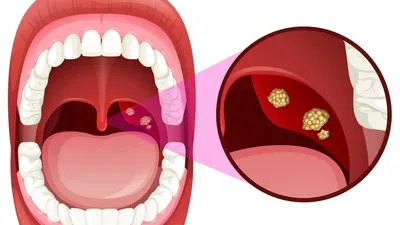 Лечение хронического тонзиллита: что важно знать пациенту