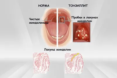 Тонзиллит опасен тяжелыми осложнениями | Ганцавіцкі час