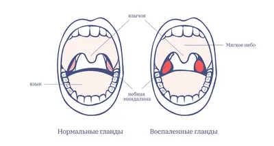 Удаление миндалин лазером | Лор Клиника \"Солнце\"