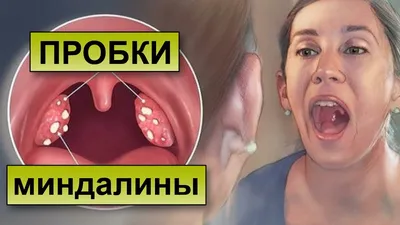 Отзыв о Тонзиллэктомия или удаление миндалин | Тем, кому врач сказал, что  лучше удалять - не медлите