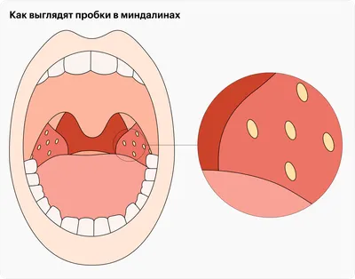 Когда нужно удалять гланды? | ЛОР КЛИНИКА ЗАЙЦЕВА | Дзен