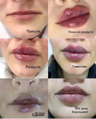 Увеличение и коррекция формы губ гиалуроновой кислотой в Jolly Clinic