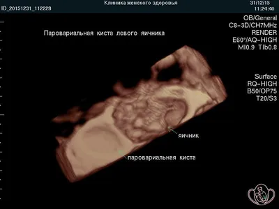 Параовариальная киста: ФОТО, диагностика, лечение | Курортная клиника  женского здоровья