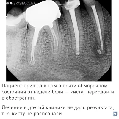 Эндометриоидная киста яичника: причины, симптомы, лечение, удаление