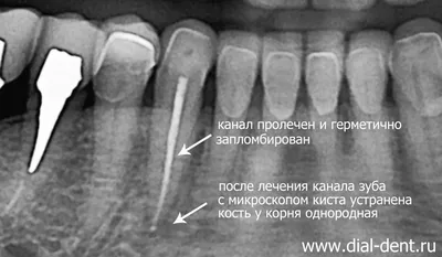 Киста почки - причины образования, диагностика и лечение