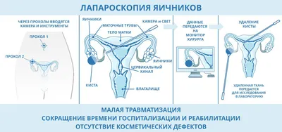 Удаление кисты гайморовой пазухи с открытым синус-лифтингом - Немецкий  Имплантологический Центр, Москва